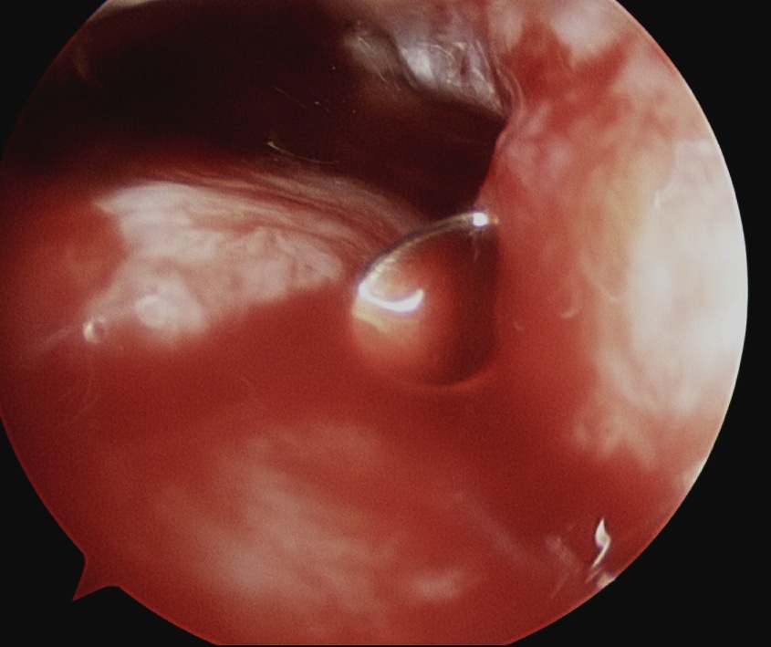 Rotator Cuff Repair PRP 1